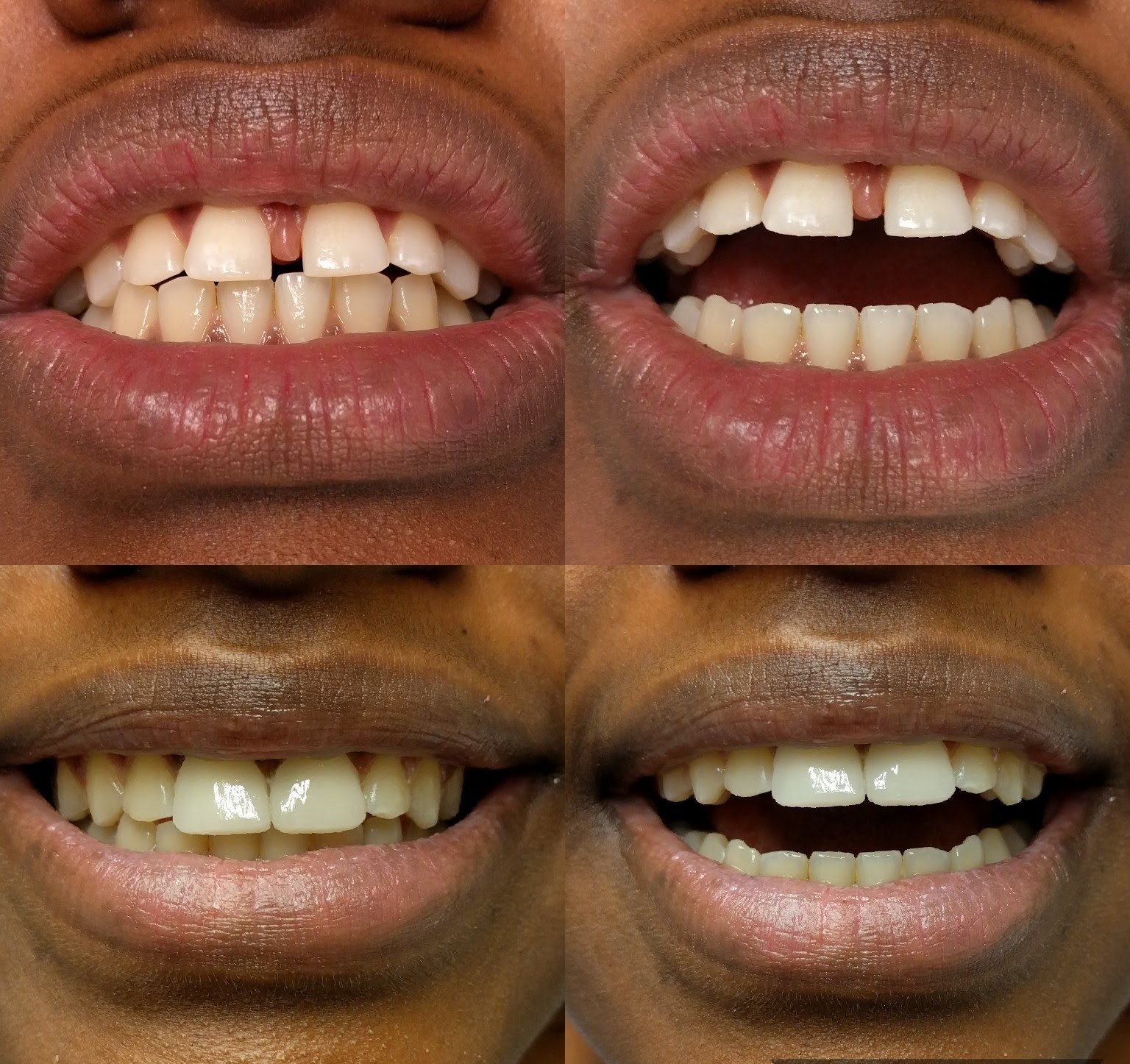 Patient before and after single tooth implant: missing upper incisor restored with a permanent implant and crown