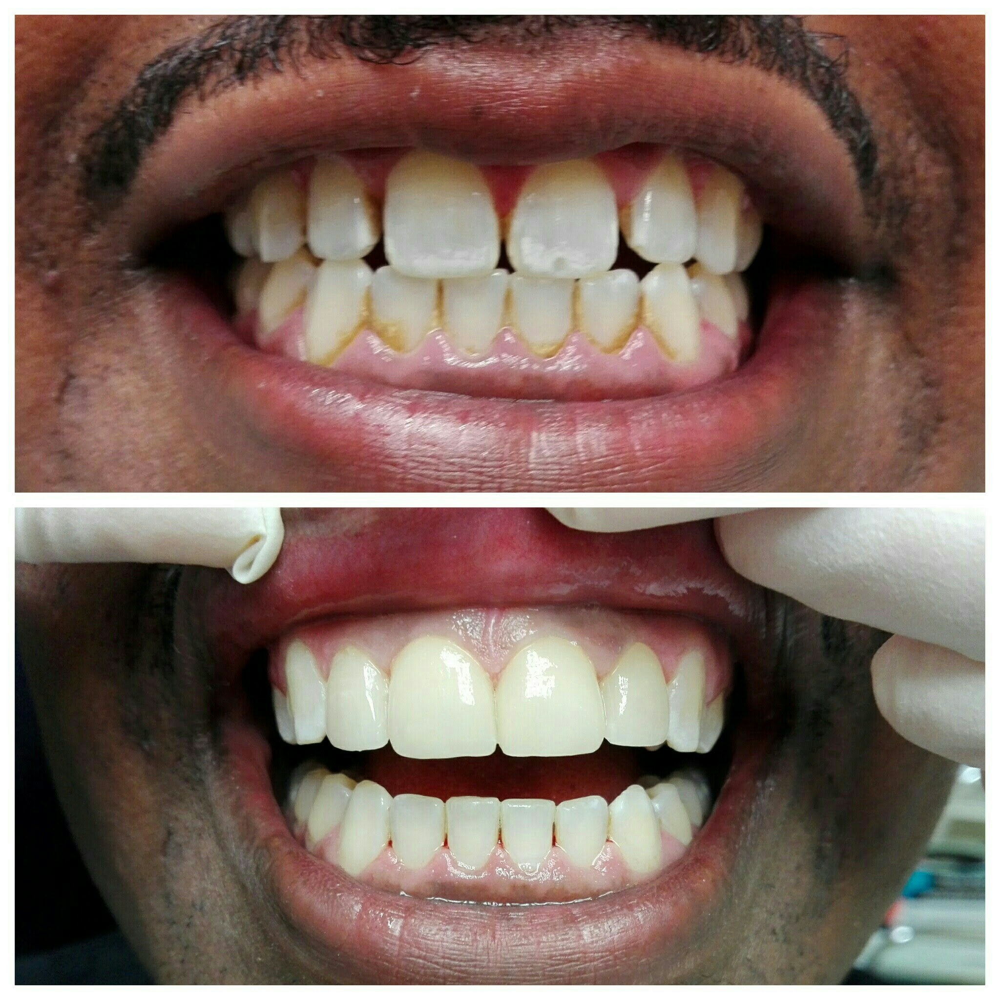 Patient before and after multiple implant restoration: gappy stained teeth replaced with a clean even smile