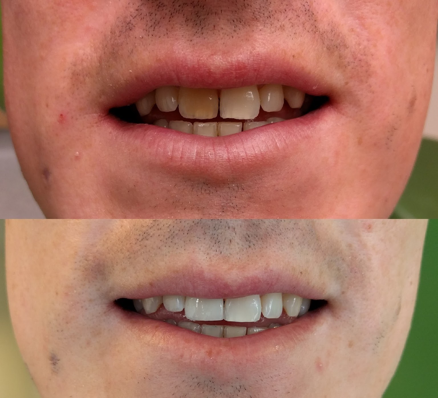 Patient before and after smile restoration: dim worn teeth replaced with a bright even smile