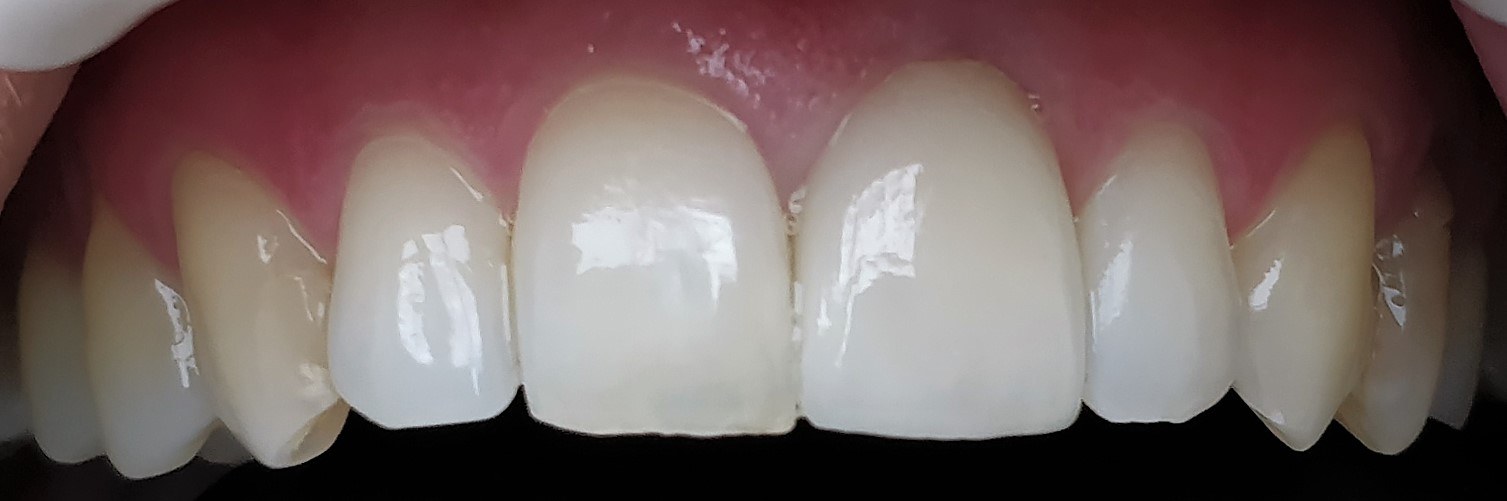 Patient after front tooth restoration, matched bright pair
